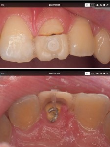 お　折れた歯を矯正して（引っ張りあげて）抜かずに使う方法（10代男性）（2015-1031）